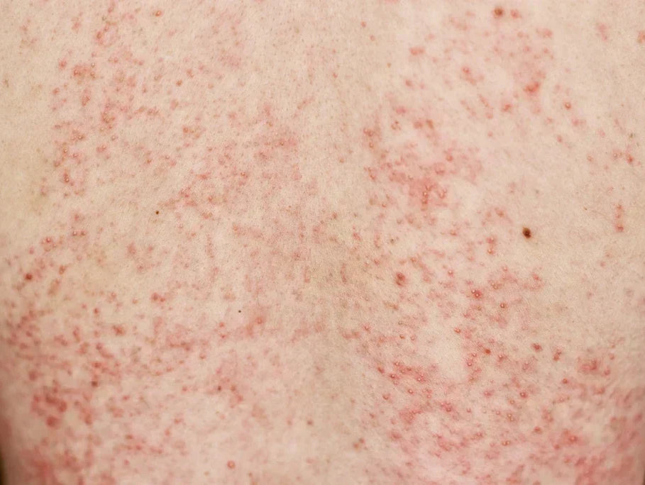 Peau atopique démangeaison rougeur