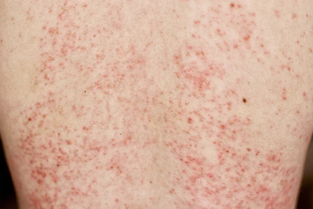Peau atopique démangeaison rougeur